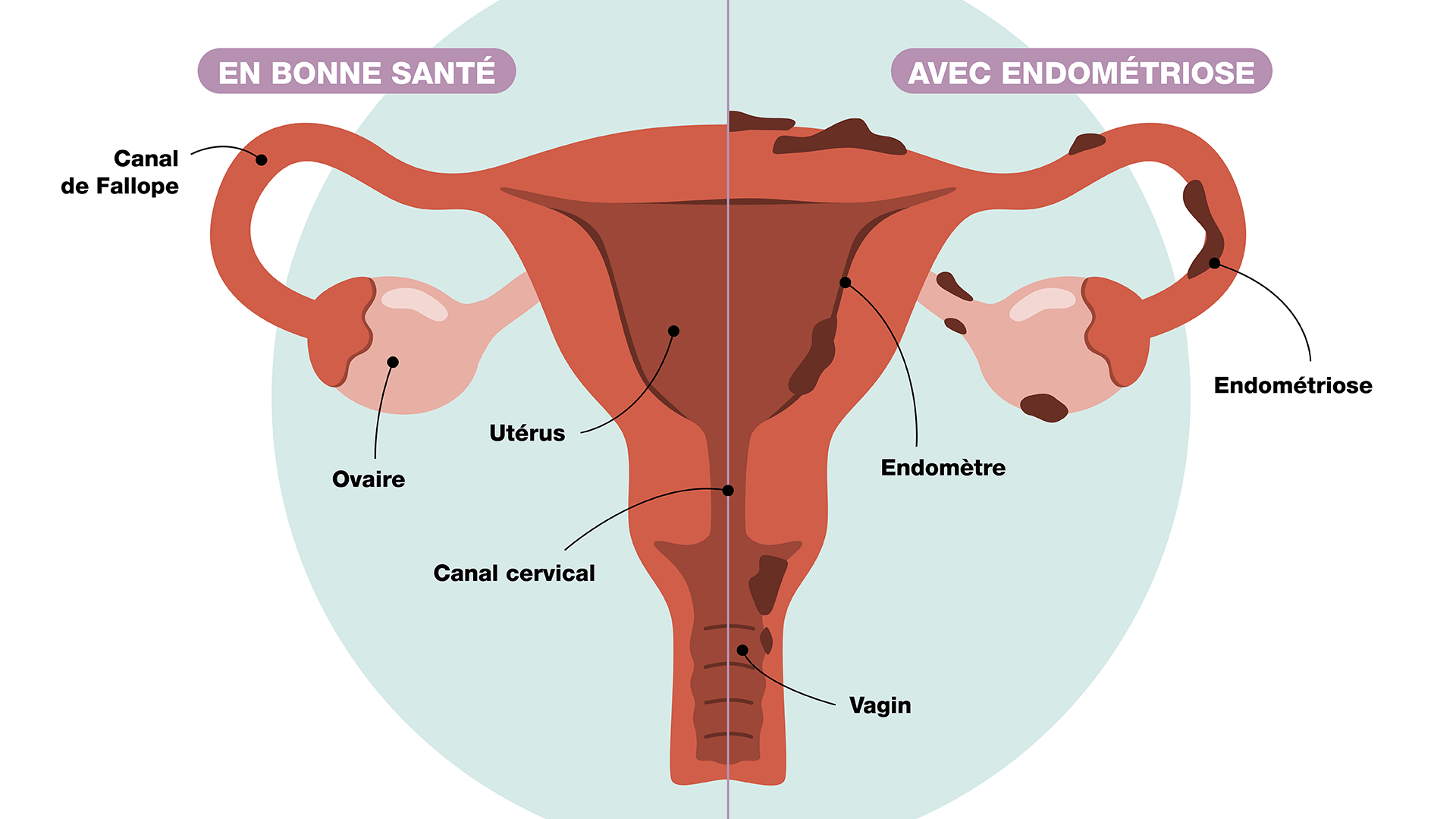schéma endometriose Lyon