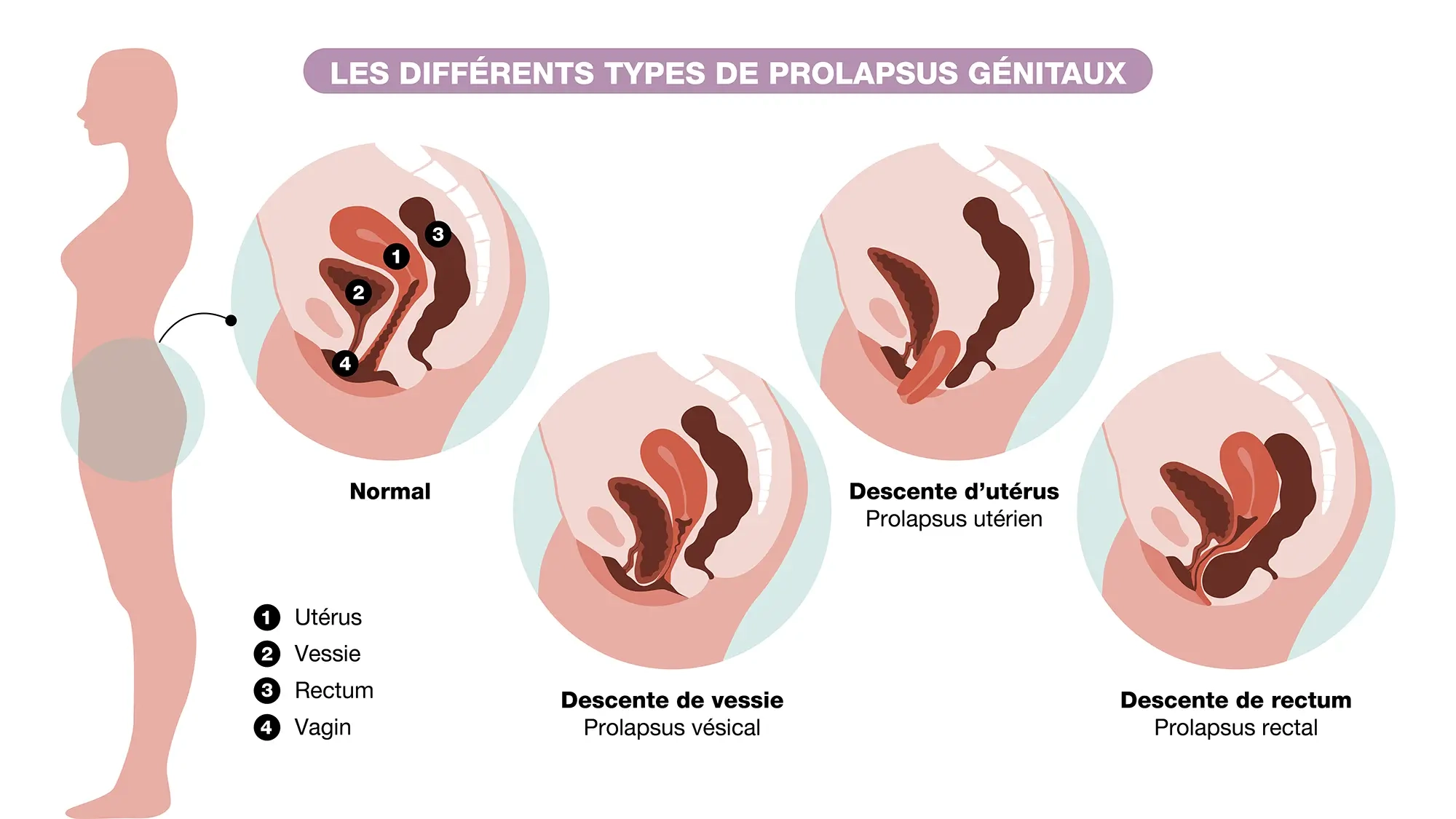 les différents types de Prolapsus génitaux